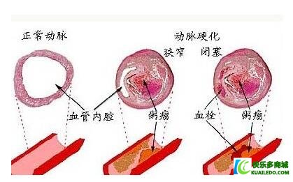 冠状动脉硬化的原因