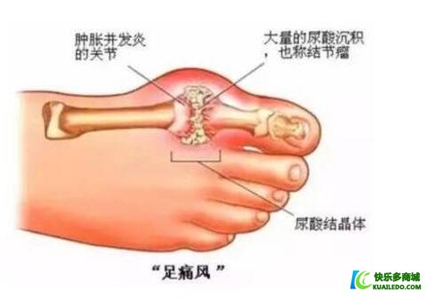 痛风会遗传吗