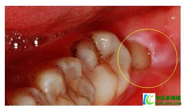 智齿要不要拔掉？