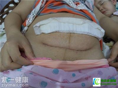 剖腹产坐月子注意事项是什么 剖腹产后恢复须谨记