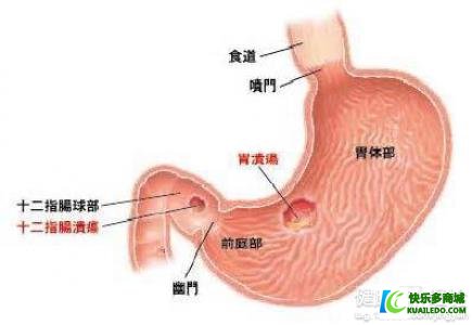 胃溃疡需与什么疾病鉴别诊断