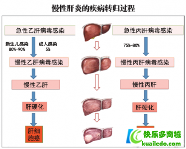 怎么保护酒精肝患者