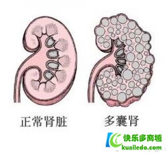 多囊肾有哪些疗养方法