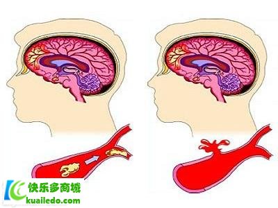 [揭密]阿司匹林适合什么人吃 推举五类人群快速防护心血管病患