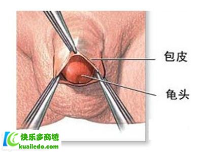 [保养分析]早泄割包皮有用吗 遇上早泄要如何保养保养