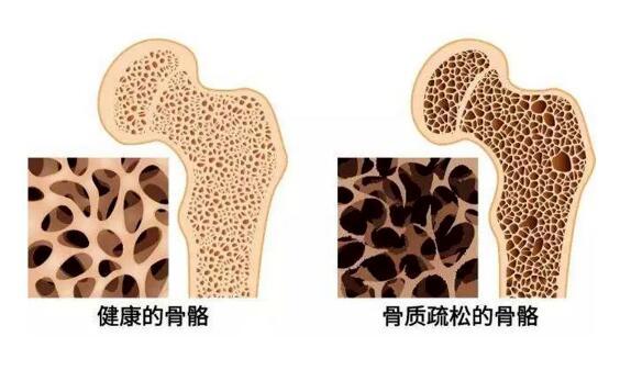 什么是骨质疏松症？怎么防治骨质疏松症