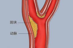 老人颈动脉斑块引起头晕需要住院输液吗